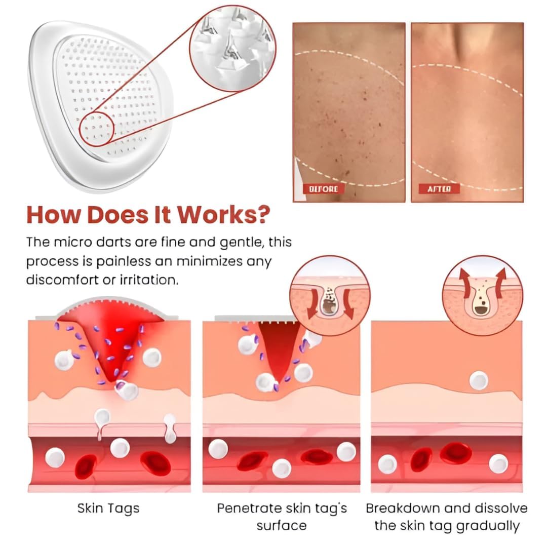 Derma Smooth Skin Tag Removal Patch | Secret To Spotless Skin