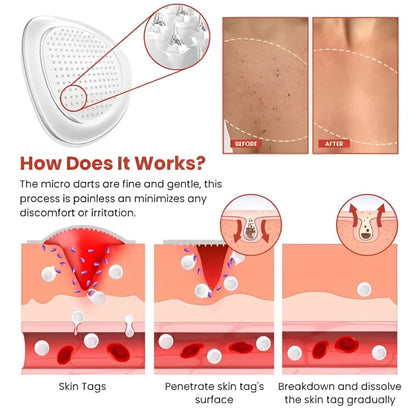 Derma Smooth Skin Tag Removal Patch | Secret To Spotless Skin